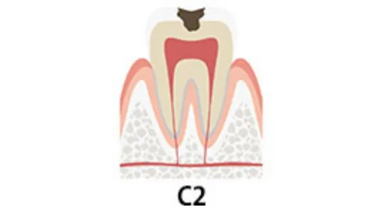 【C2】中度の⾍⻭（象⽛質の⾍⻭）