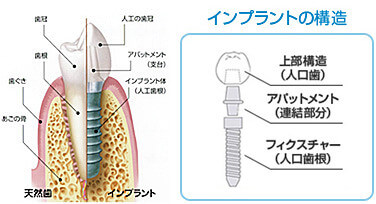 インプラントの構造について