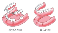入れ歯