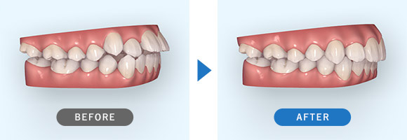 矯正治療後の歯ならびの変化1