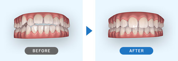 矯正治療後の歯ならびの変化2