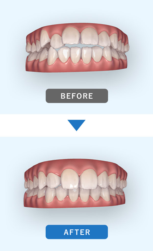矯正治療後の歯ならびの変化2
