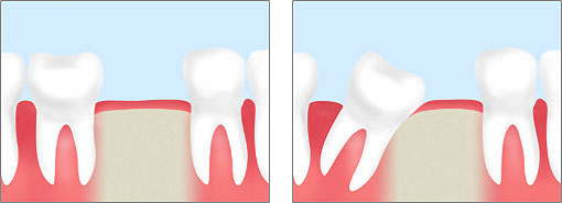 歯の症例