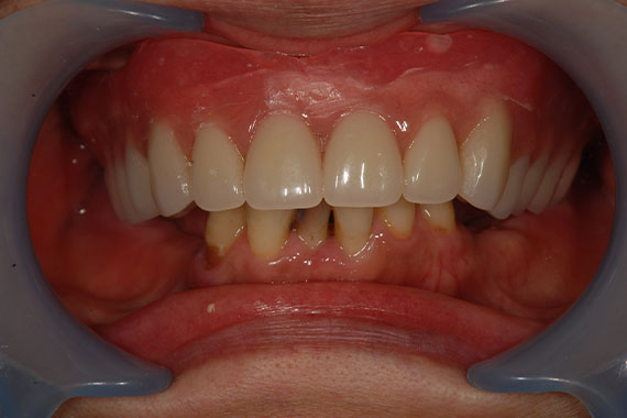 「入れ歯からインプラントに切り替えて何でもおいしく食べられる歯に！」 BEFORE画像