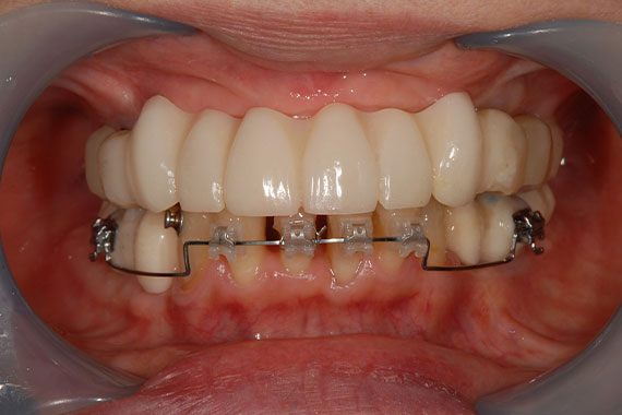 入れ歯からインプラントに切り替えて何でもおいしく食べられる歯に！ 症例写真02