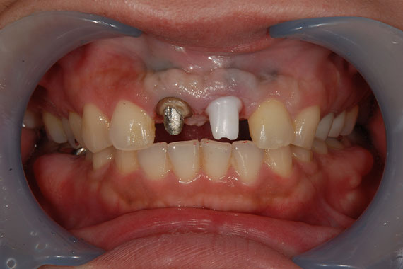 前歯のインプラントで審美＆機能どちらもUP 症例写真01